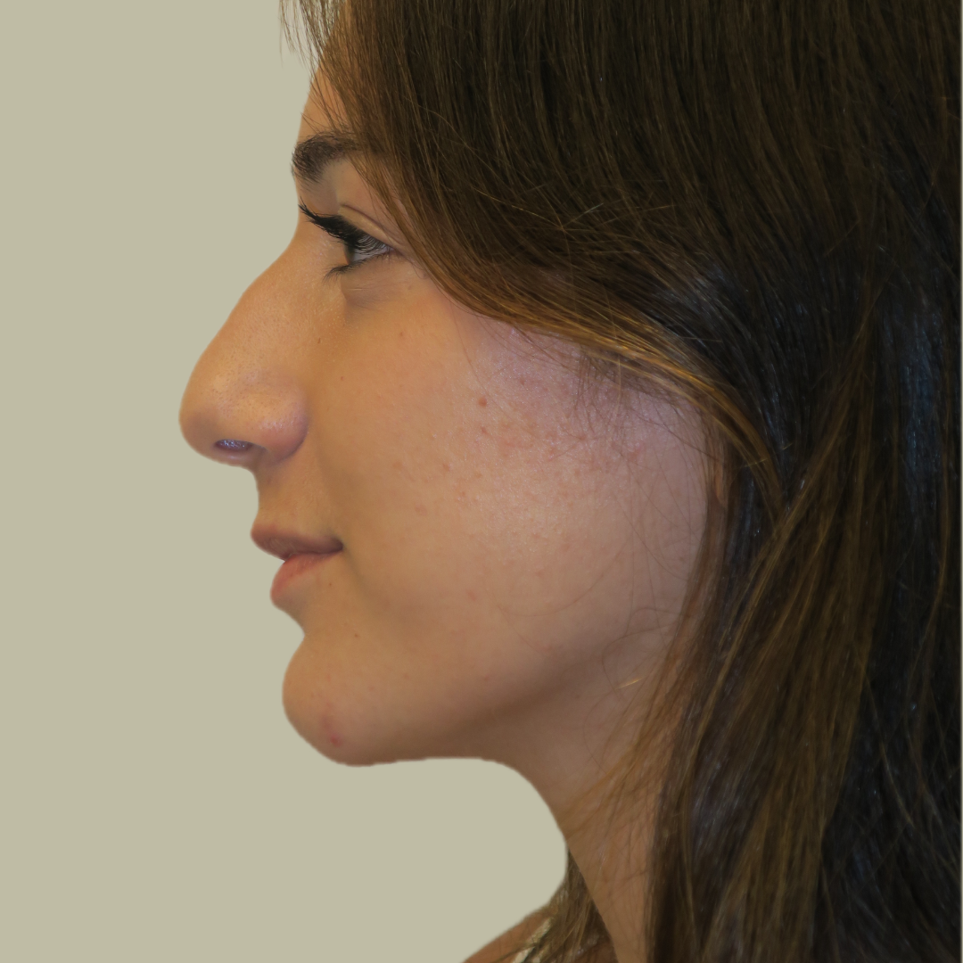 Rinoplastia Rinoplastia