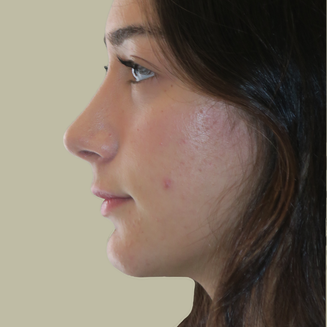 Rinoplastia Rinoplastia