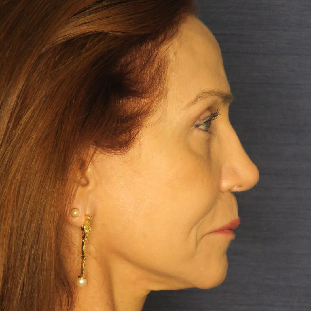 Ritidoplastia – Dr. Rodolfo Lobato Ritidoplastia - Dr. Rodolfo Lobato