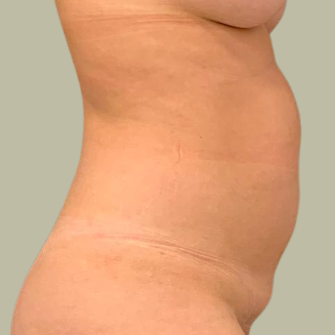 Abdominoplastia Pré Operatório Abdominoplastia Pré Operatório