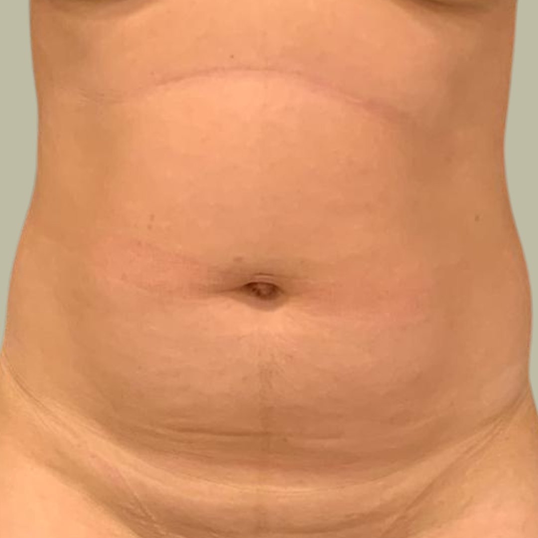 Abdominoplastia Pré Operatório Abdominoplastia Pré Operatório