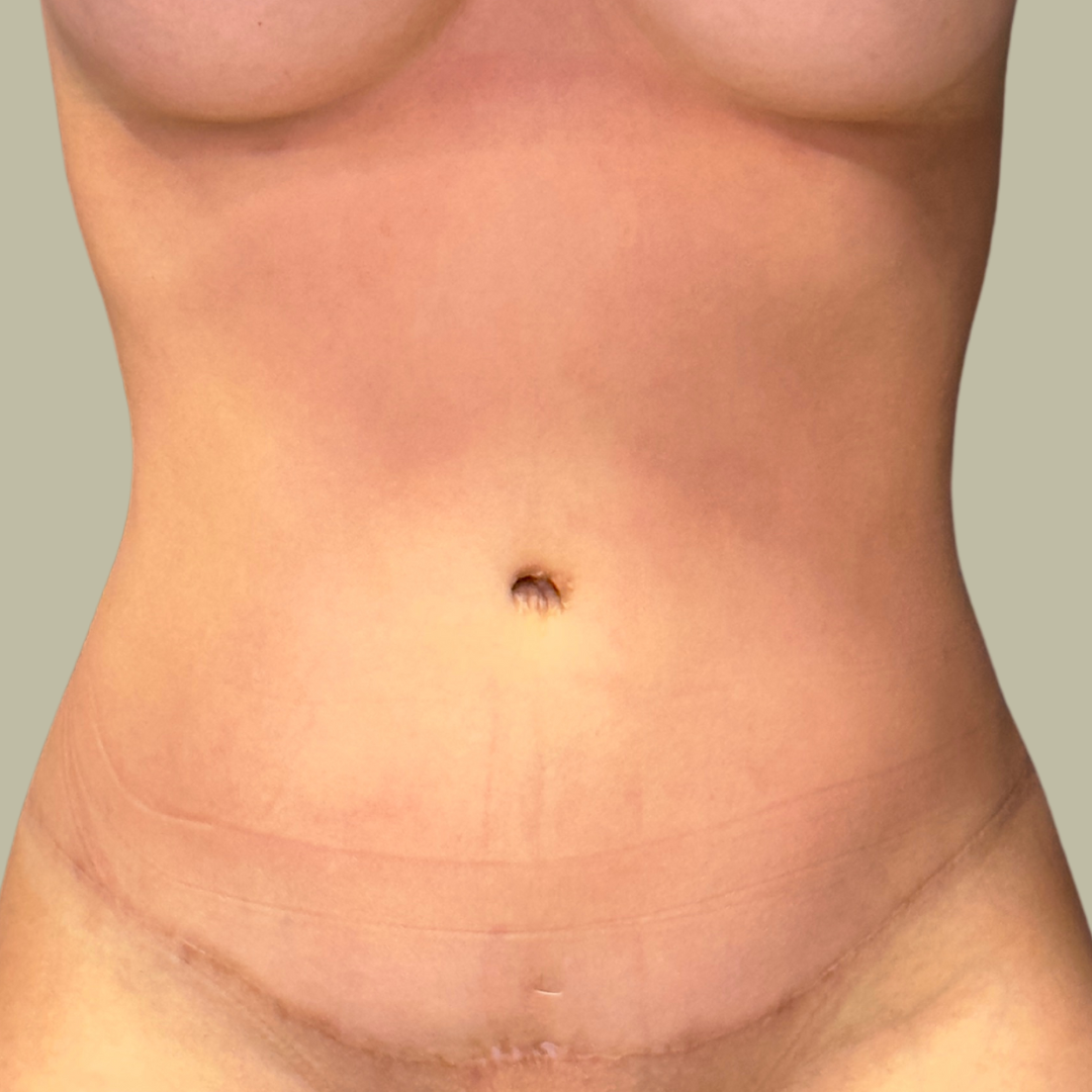 Abdominoplastia Pós Operatório