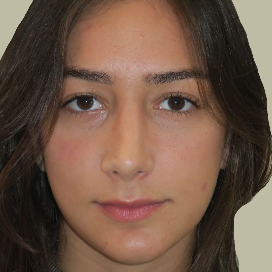 Rinoplastia Rinoplastia