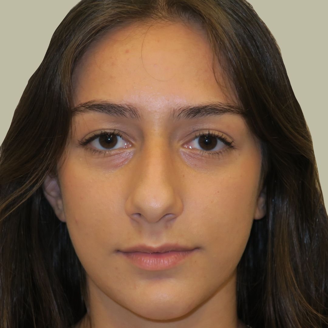 Rinoplastia Rinoplastia