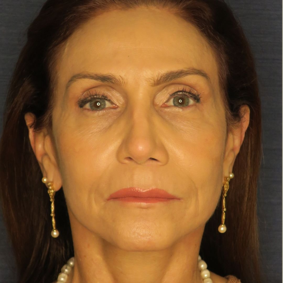 Ritidoplastia – Dr. Rodolfo Lobato Ritidoplastia - Dr. Rodolfo Lobato