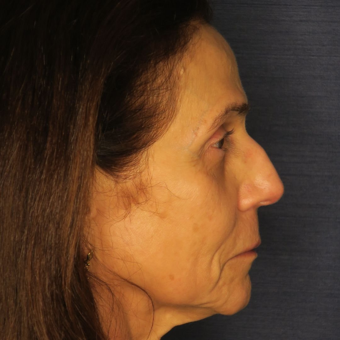 Ritidoplastia – Dr. Rodolfo Lobato Ritidoplastia - Dr. Rodolfo Lobato